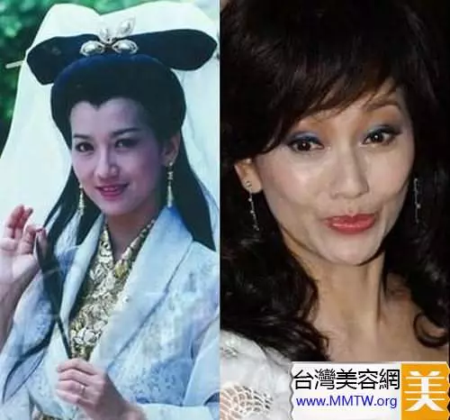 46歲鍾麗緹遭偷拍「臉上滿滿針孔」!女星為了不老「亂打針的下場」竟是....嚇到腿軟!
