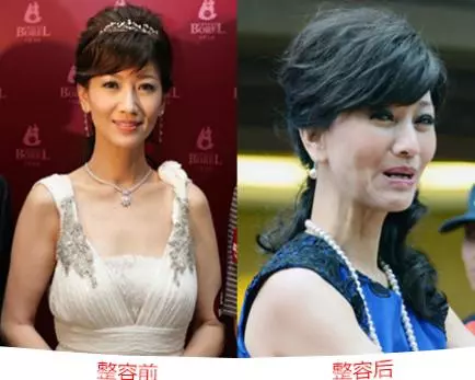 46歲鍾麗緹遭偷拍「臉上滿滿針孔」!女星為了不老「亂打針的下場」竟是....嚇到腿軟!