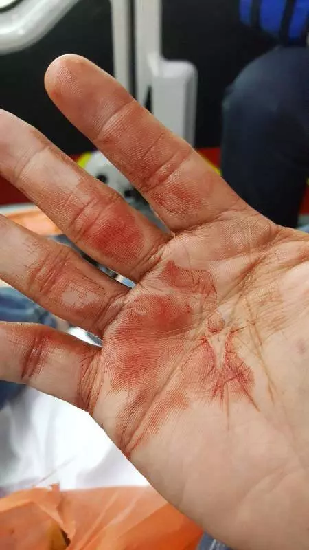 舌尖上的驚魂 喝咖啡喝到滿口血