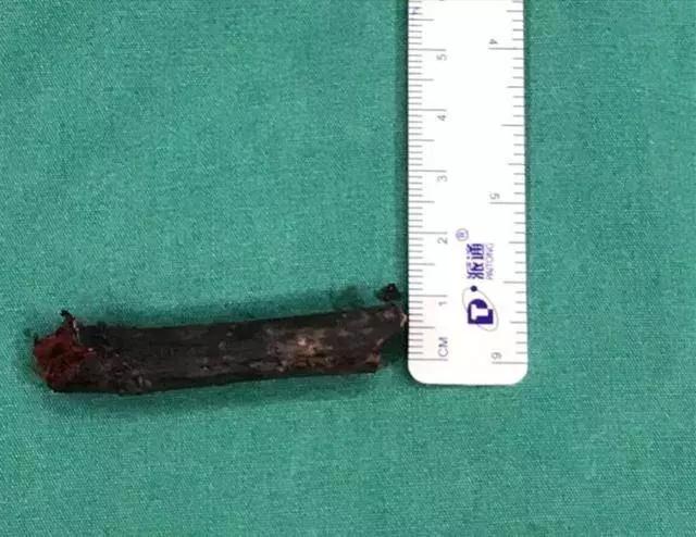 8歲男孩嘴裡這東西腐爛發黑!醫生都驚呆了!