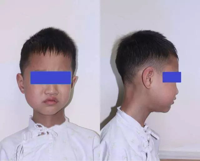 8歲男孩嘴裡這東西腐爛發黑!醫生都驚呆了!
