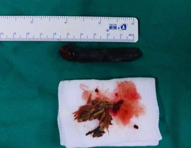 8歲男孩嘴裡這東西腐爛發黑!醫生都驚呆了!
