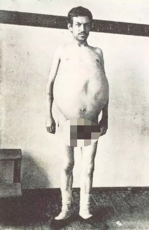 他是「全世界擁有最大啤酒肚」的男性,在他離世後,醫生剖腹竟發現原來他肚子裡裝的都是「這些」!