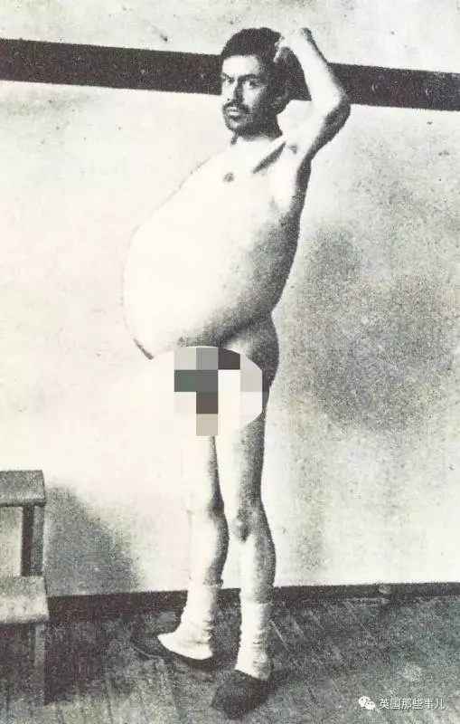他是「全世界擁有最大啤酒肚」的男性,在他離世後,醫生剖腹竟發現原來他肚子裡裝的都是「這些」!