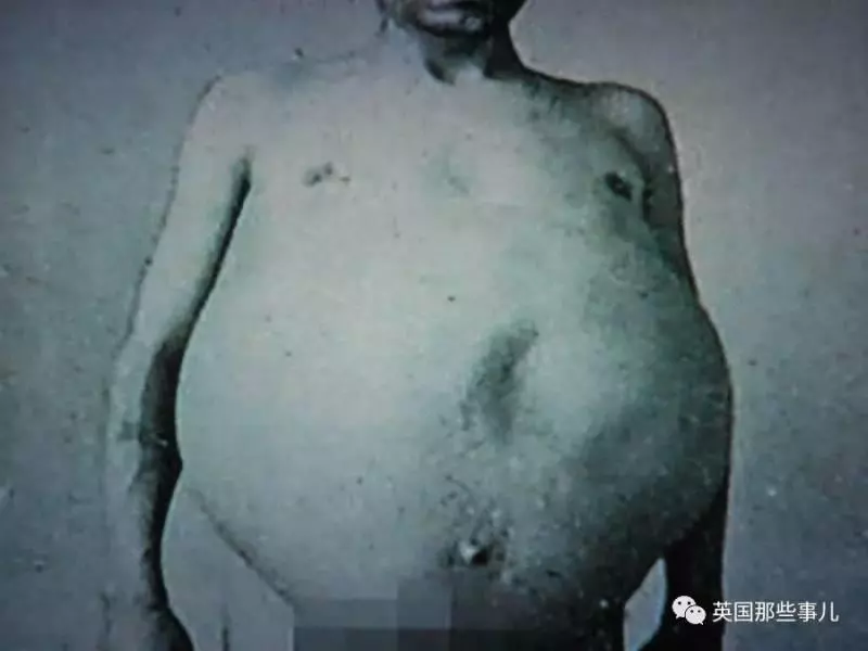 他是「全世界擁有最大啤酒肚」的男性,在他離世後,醫生剖腹竟發現原來他肚子裡裝的都是「這些」!