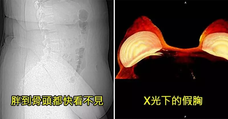 15個「只在你腦袋浮現卻從沒看過」的驚奇人體X光照 小孩乳牙+恆齒竟然有4排!
