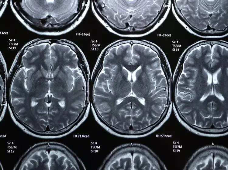 10個打破你思維的「人類大腦驚奇知識」 過度節食大腦會開始「吃它自己」!