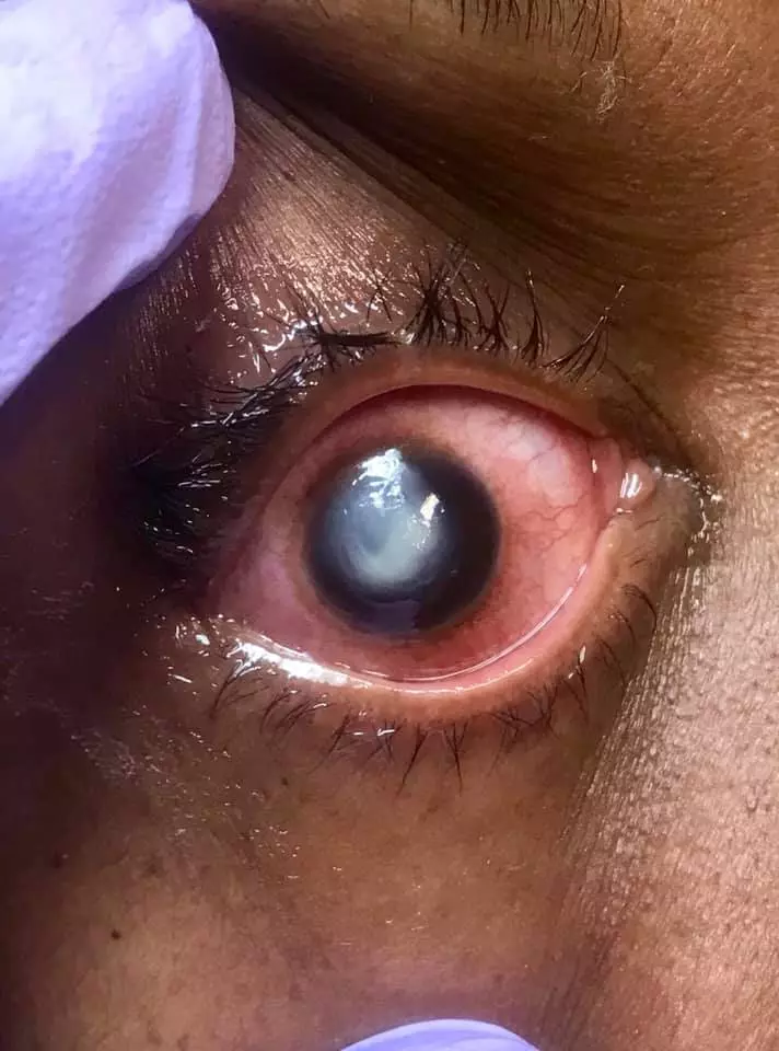 真實案例‼️ 女子戴Contact Lens睡覺, 醒來後眼角膜被『細菌蠶食』, 36小時就可致失明!
