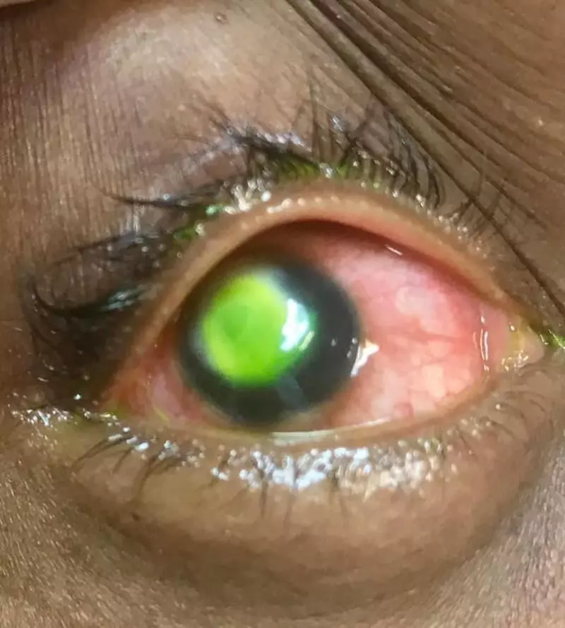 真實案例‼️ 女子戴Contact Lens睡覺, 醒來後眼角膜被『細菌蠶食』, 36小時就可致失明!