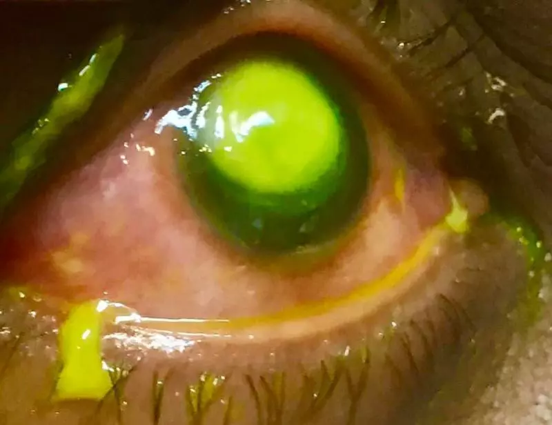 真實案例‼️ 女子戴Contact Lens睡覺, 醒來後眼角膜被『細菌蠶食』, 36小時就可致失明!