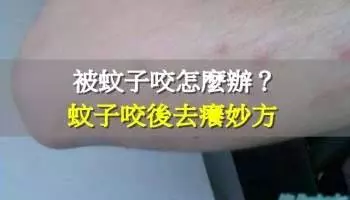 被蚊子咬怎麽辦?最棒的「止癢」方法!90%的人都不知道的妙招