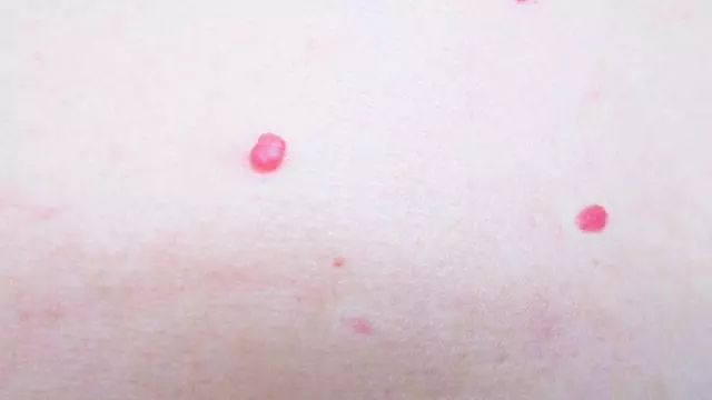 肝病學家講解:身上長出2種「小紅點」, 是肝癌在警告你!