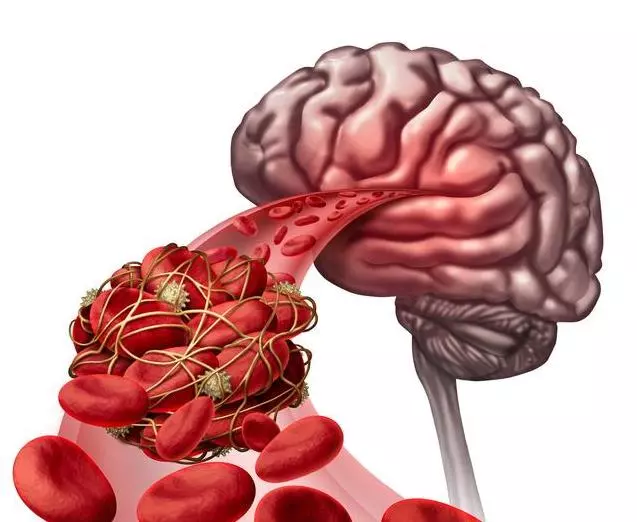 醫生提醒:過了50歲,不想中風,3種食物要儘量遠離,多做2件事,腦血管越來越乾淨