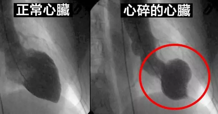 人真的會「心碎嗎」？科學家證實[失去摯愛心碎是真的]可能嚴重到甚至還會讓「心臟停止跳動」！