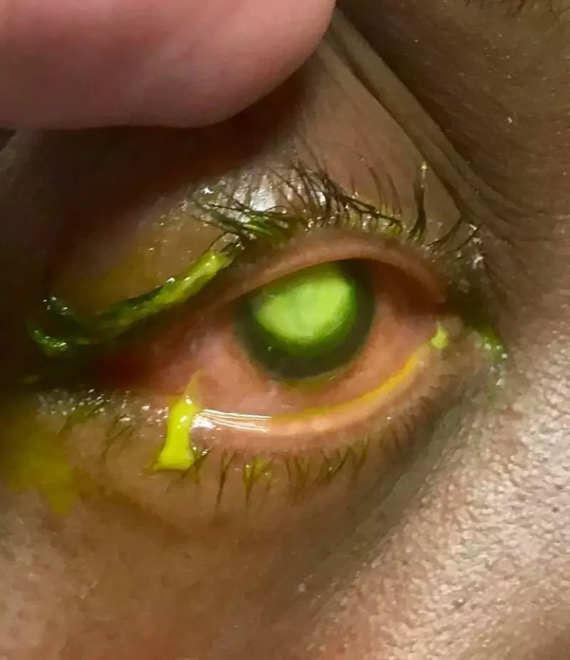 她戴隱眼睡覺,眼球變白「狂流螢光液體」...下場超恐怖!