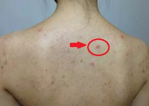 皮膚上出現3種症狀,你家蟎蟲已經「做窩」了,教你4個土辦法,蟎蟲消滅乾淨