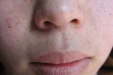 皮膚上出現3種症狀,你家蟎蟲已經「做窩」了,教你4個土辦法,蟎蟲消滅乾淨