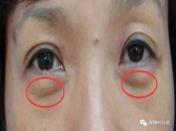 千萬別傻傻割眼袋了,兩個小妙招,7天急速撫平眼袋消除黑眼圈!