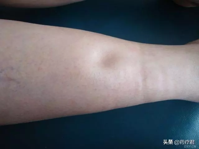 心血管不好的人,皮膚可能會發生這些病變,不要再視而不見了!