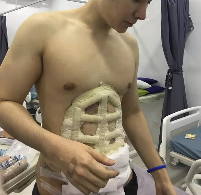 肚肚肥肉抽脂秒變「8塊腹肌」 新整形成果網驚:看不出來!