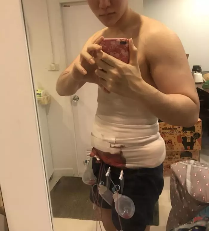 肚肚肥肉抽脂秒變「8塊腹肌」 新整形成果網驚:看不出來!