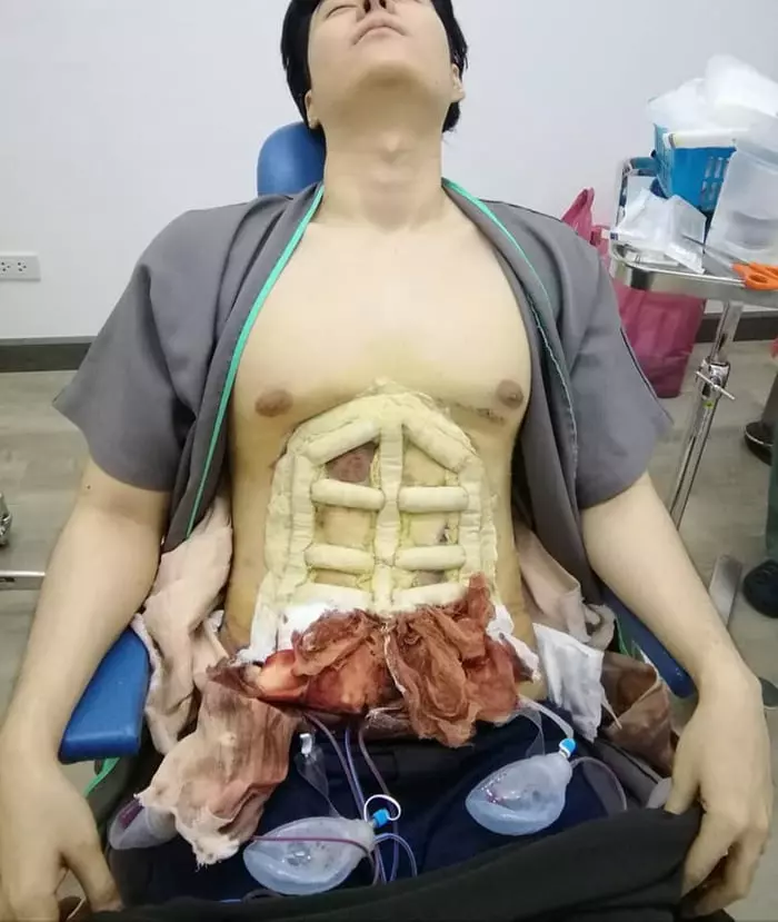 肚肚肥肉抽脂秒變「8塊腹肌」 新整形成果網驚:看不出來!