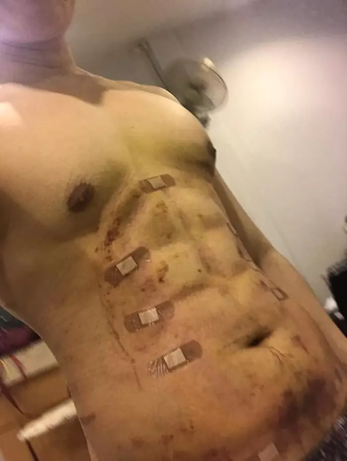 肚肚肥肉抽脂秒變「8塊腹肌」 新整形成果網驚:看不出來!