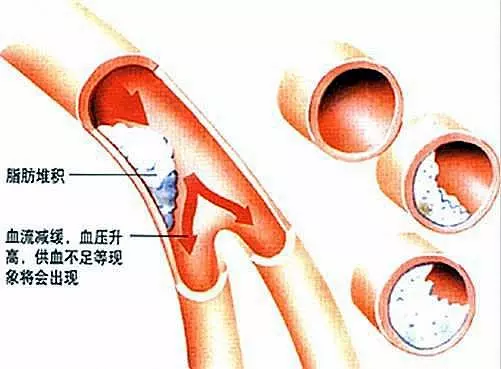 腿上出現這種信號,說明血脂已經很高了,別太晚知道了~