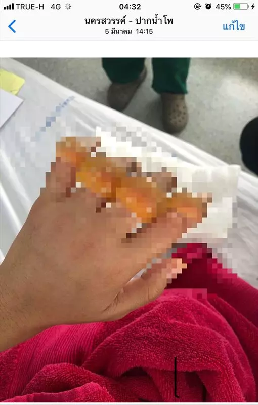 女大生飯店實習驚傳意外 纖細手指「發黑腫成球」被迫斷指