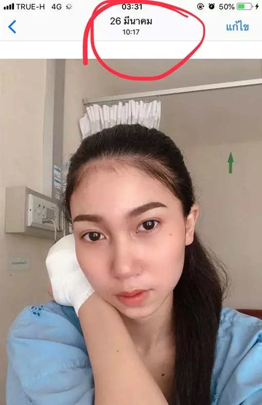 女大生飯店實習驚傳意外 纖細手指「發黑腫成球」被迫斷指