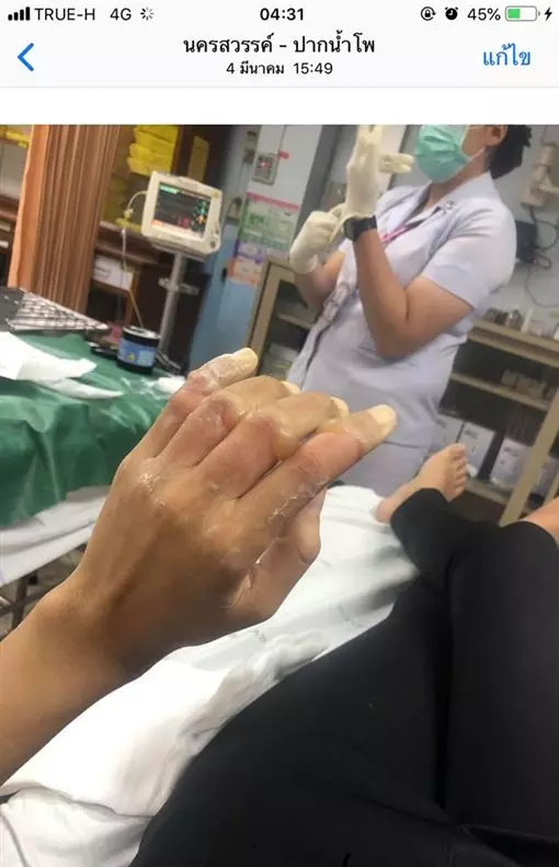 女大生飯店實習驚傳意外 纖細手指「發黑腫成球」被迫斷指
