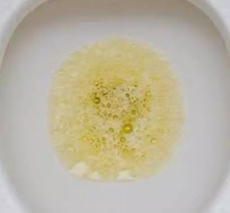 注意!身上出現這幾個癥狀,證明你「血糖」太高了!尤其是你的「尿液」變成這樣,容易發展成「尿毒症了」!
