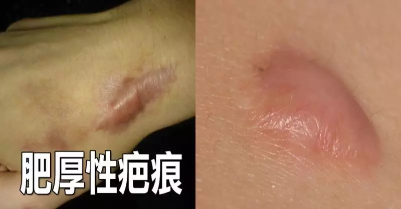 皮膚經常出現消不掉的「肥厚性疤痕」?善用「天然療法」縮小疤痕
