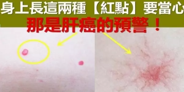 專家警告:身上長出2種「小紅點」, 小心你已經被肝癌纏上了!想避免後半生躺床,就少接觸這「三種」東西!