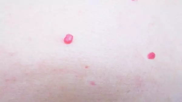 專家警告:身上長出2種「小紅點」, 小心你已經被肝癌纏上了!想避免後半生躺床,就少接觸這「三種」東西!