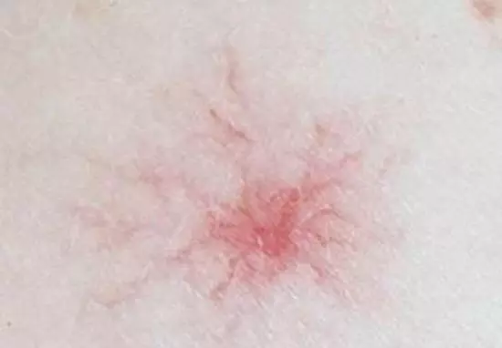 專家警告:身上長出2種「小紅點」, 小心你已經被肝癌纏上了!想避免後半生躺床,就少接觸這「三種」東西!