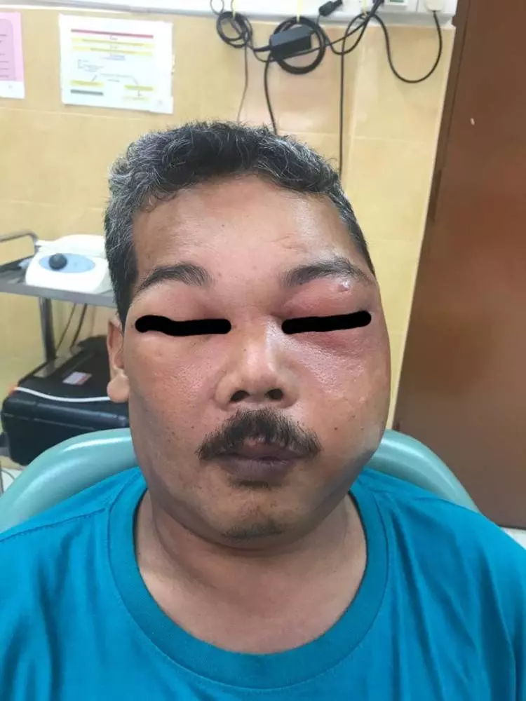 馬來大叔相信「牙齦塗摩托剎車油」能治牙痛! 結果臉腫2倍...臉頰開洞狂流膿!