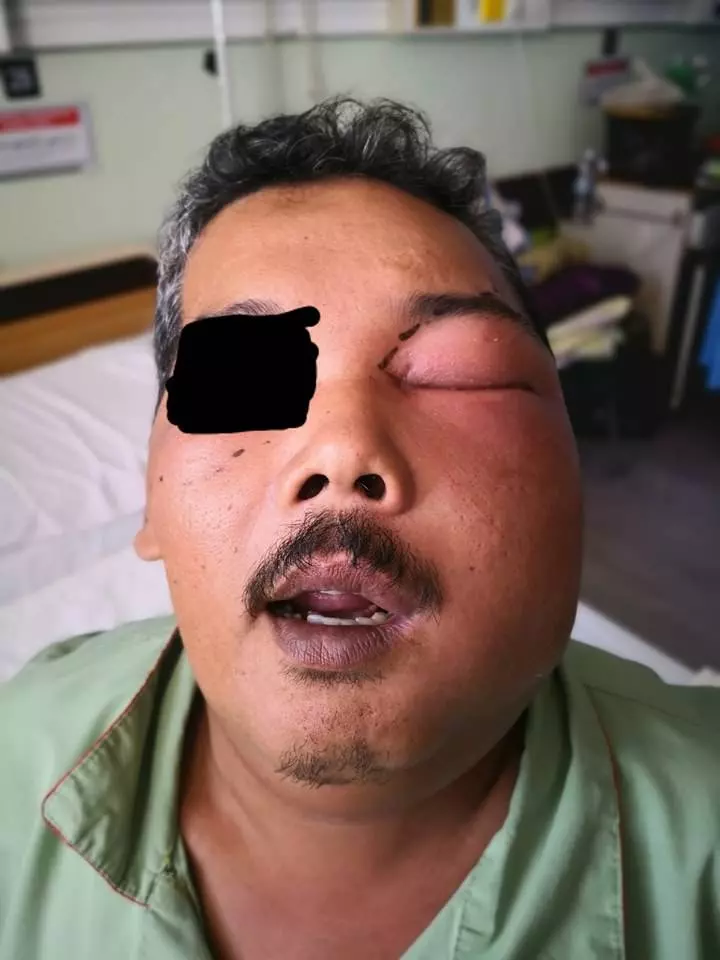 馬來大叔相信「牙齦塗摩托剎車油」能治牙痛! 結果臉腫2倍...臉頰開洞狂流膿!
