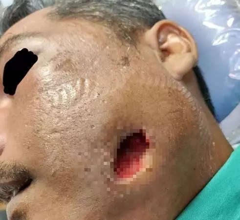 馬來大叔相信「牙齦塗摩托剎車油」能治牙痛! 結果臉腫2倍...臉頰開洞狂流膿!