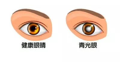 眼部寒冷損傷視神經小心青光眼,眼科醫師:一條毛巾護眼一把罩