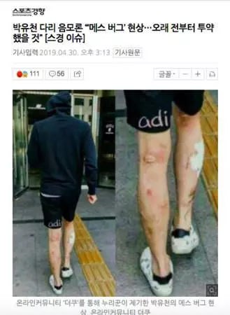 吸毒害皮膚潰爛?韓媒曝光朴有天,腳、手全都爛掉
