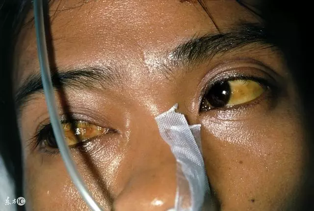 26歲女查出肝癌離世,醫生解釋:兩個習慣害的!