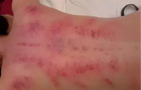 背部刮痧,可以看出一個人的身體健康狀況!