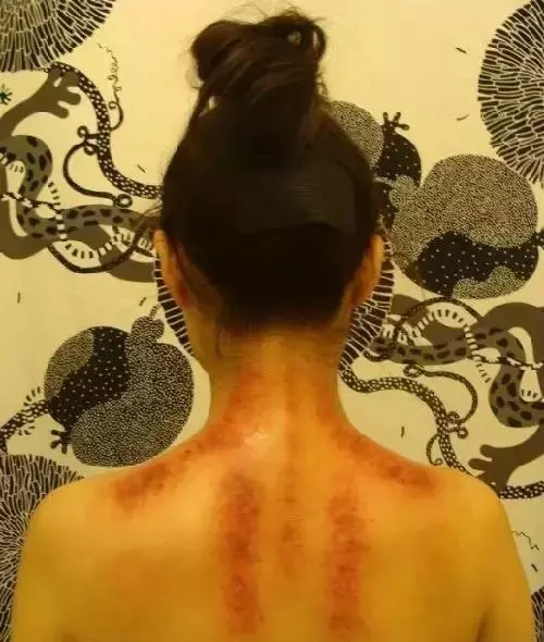 背部刮痧,可以看出一個人的身體健康狀況!