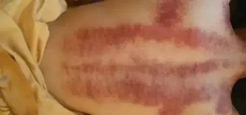 背部刮痧,可以看出一個人的身體健康狀況!