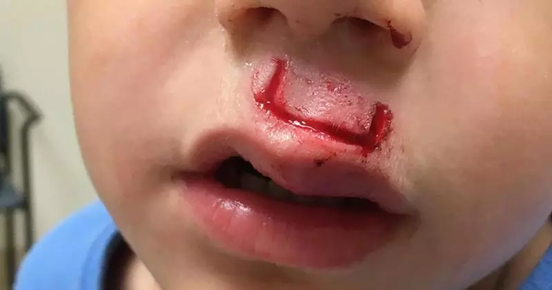 父母亂玩指尖陀螺「造成兒子的臉被炸到縫30針」,這種玩具已經讓許多家長受驚、孩子受傷!