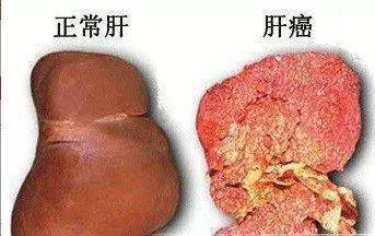 肝病化療也沒用?這3種東西常吃,修復肝細胞見效快,預防肝炎、肝硬化