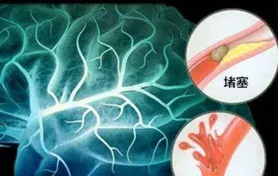 為什麼「中風」越來越多?醫生奉勸:3種食物別吃,會「加速」血管堵塞,再喜歡也要忌口