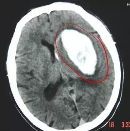 為什麼「中風」越來越多?醫生奉勸:3種食物別吃,會「加速」血管堵塞,再喜歡也要忌口