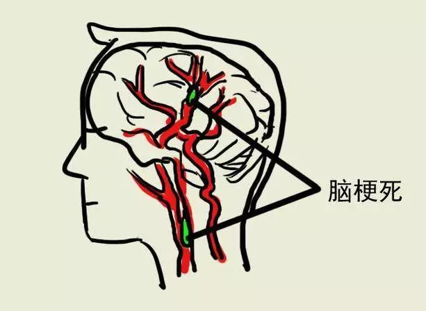 醫生提醒:睡覺時有這種表現是【中風】前兆,一定要警惕